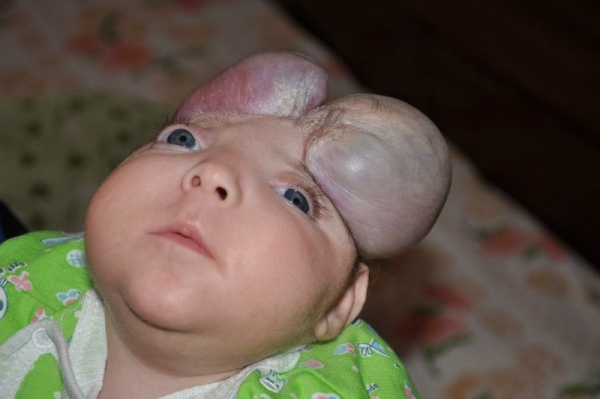В Одессе живёт единственный в мире ребёнок без черепа
