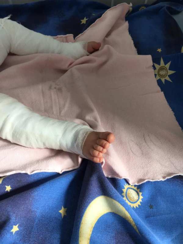"Кипяток страшнее огня": в Белгород-Днестровском районе 11-месячный малыш получил 80% ожогов тела, упал в ведро с горячей водой