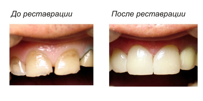 Художественная реставрация зубов: методы