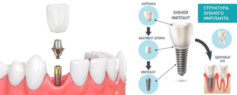 Как установить надежный зубной имплант?